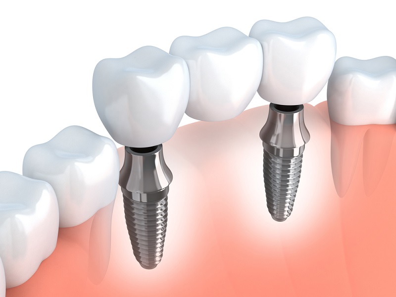 Dental implants medical illustration