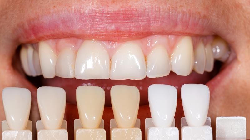 Veneers Grand Prairie, TX